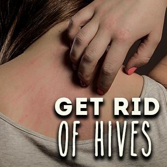 Cure Hives Hypnosis