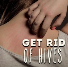 Get Rid Of Hives Hypnosis